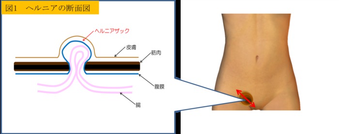 ヘルニアの断面図