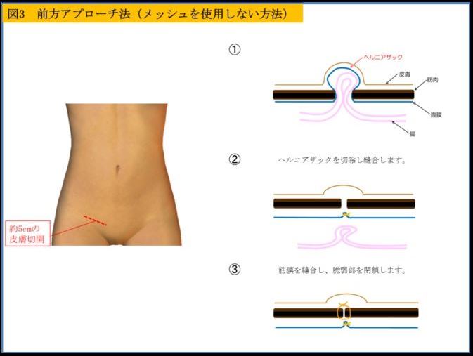 前方アプローチ法（メッシュ使用）