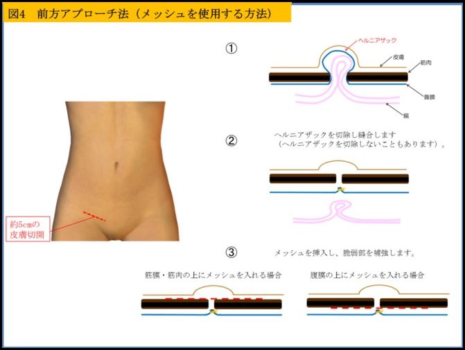 前方アプローチ法（メッシュ不使用）