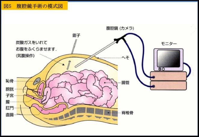 腹腔鏡手術の模式図