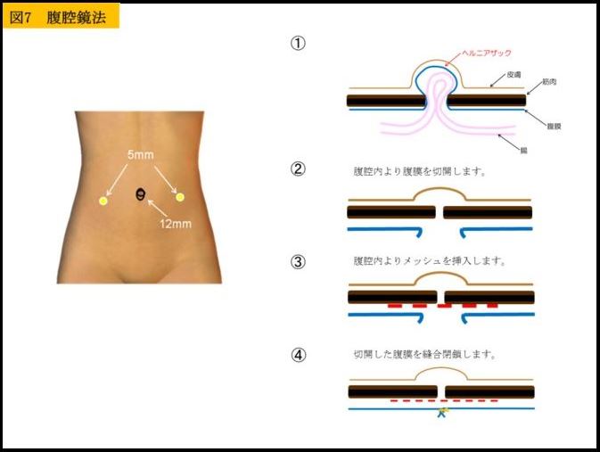 腹腔鏡法