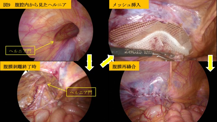 腹腟内から見たヘルニア