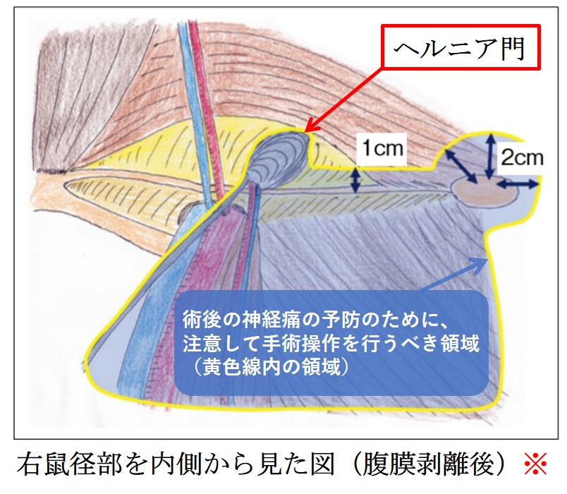 鼠径 ヘルニア 手術 後 の 痛み