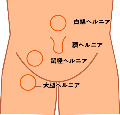 一般的なヘルニアの例は以下となります。