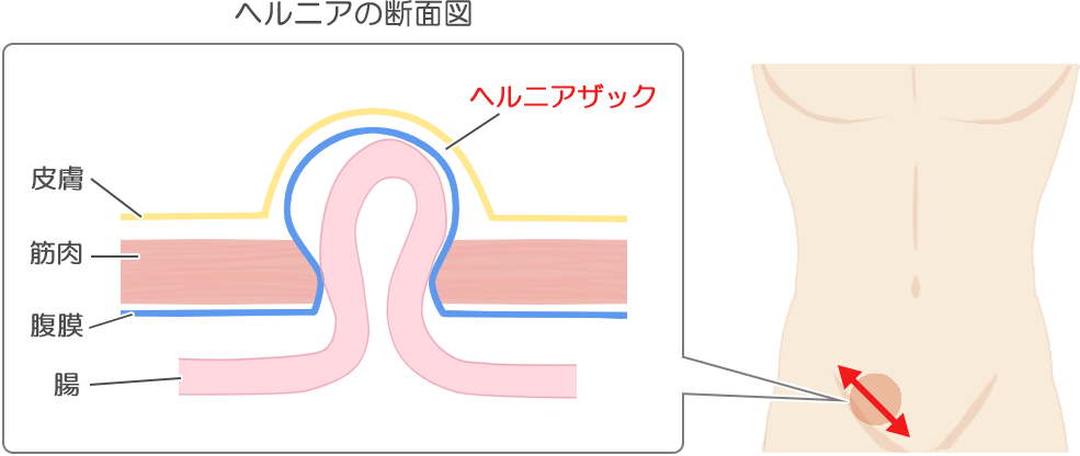 鼠径ヘルニア 断面図