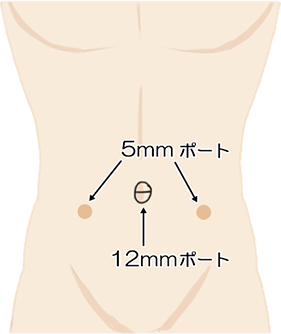 腹腔鏡法