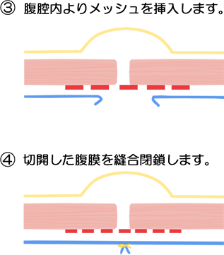 腹腔鏡法