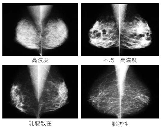 マンモグラフィと乳腺エコー 医療法人ひらまつ病院